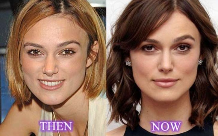 Grab All Details of Keira Knightley Plastic Surgery - Before & After Comparision